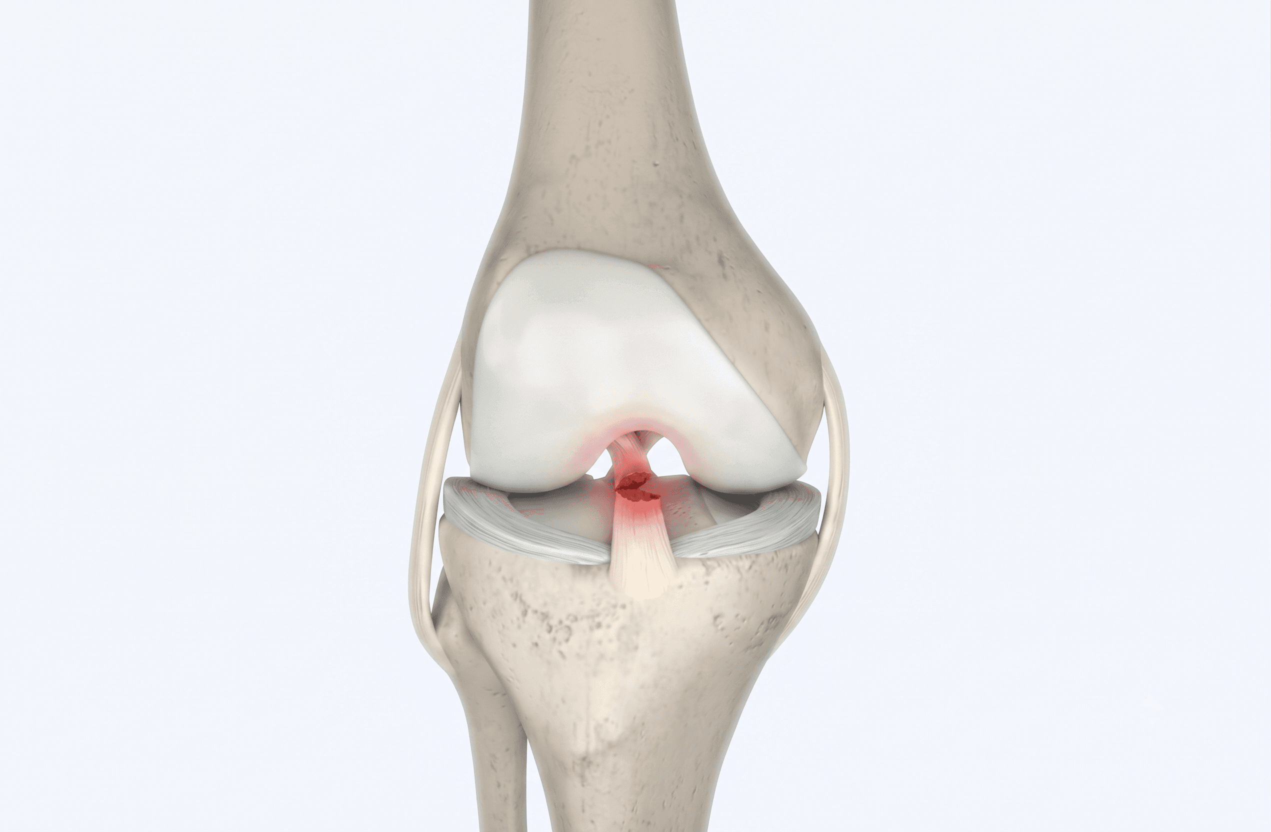 ACL & Ligament Reconstruction