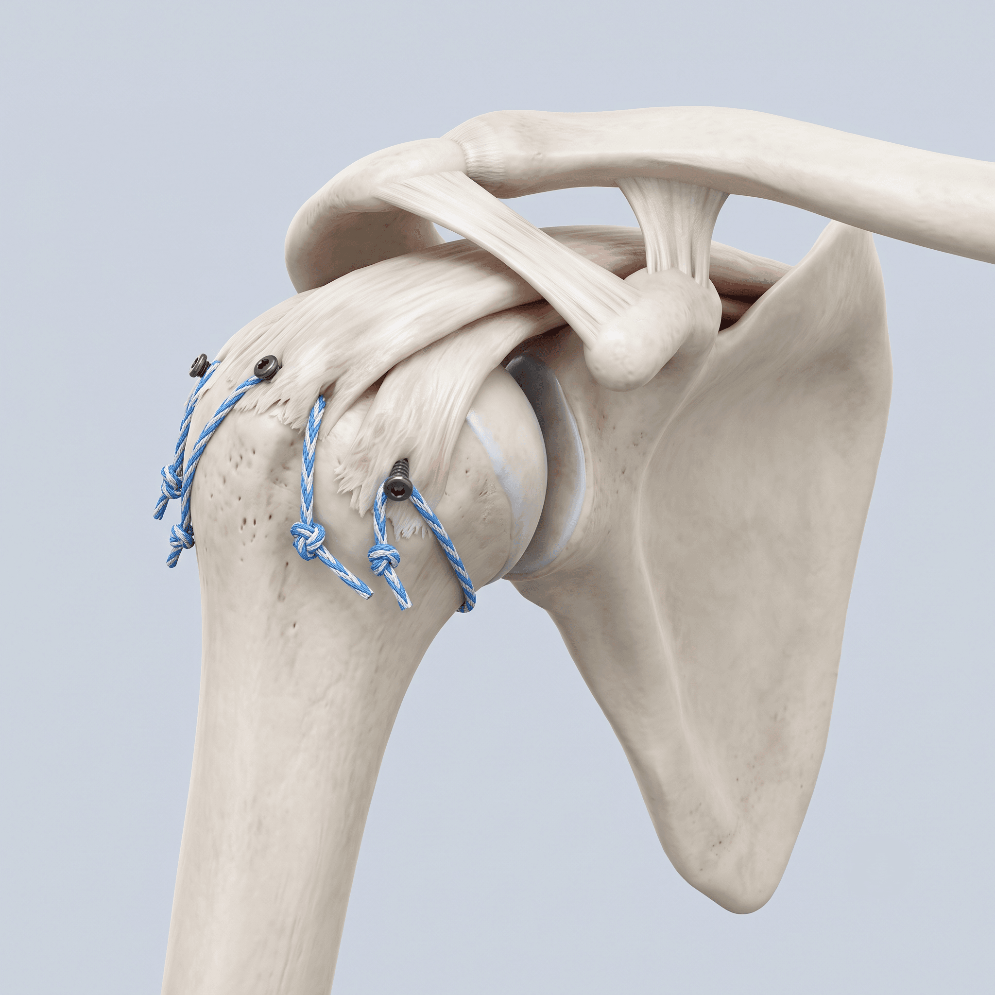 Rotator Cuff Repair