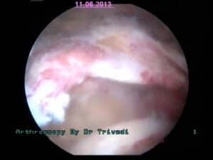 rotator cuff pEEK implants