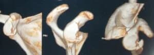Repair Of Recurrent Dislocated Of Shoulder Using BiodegradableRepair Of Recurrent Dislocated Of Shoulder Using Biodegradable