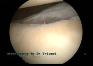Repair Of Recurrent Dislocated Of Shoulder Using Biodegradable Anchor