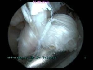 ACL Reconstruction Using Close Loop Butten & Bio-Screws